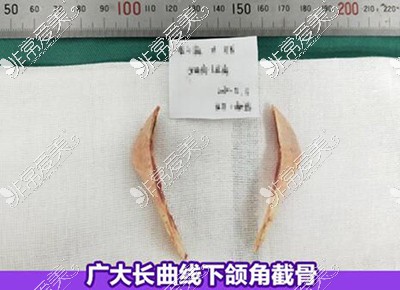 广州广大医院下颌角长曲线截骨改善