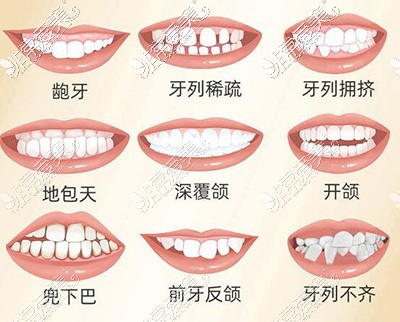 广州矫正牙齿大概要多少钱?分享广州各院正畸牙齿价格表!