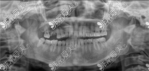 上海星诺口腔CT片 上海星诺口腔CT片