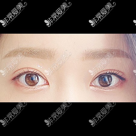 韩国icon双眼皮照片