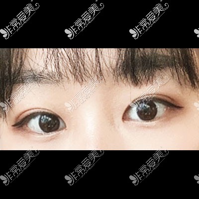 韩国icon双眼皮整形照片