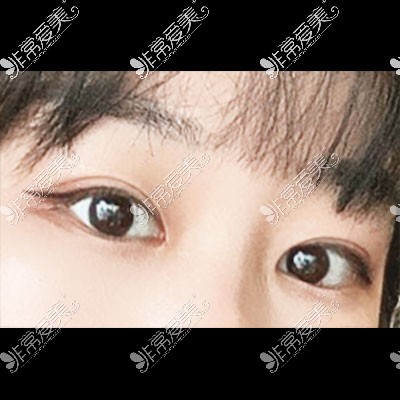 韩国icon双眼皮整形术后照