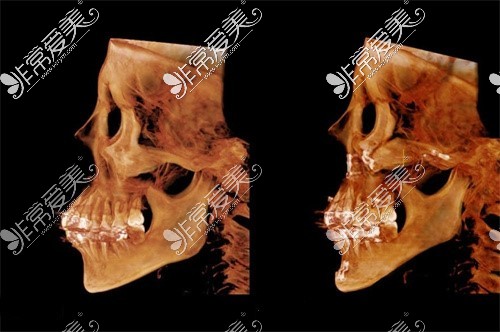 金一秀颧骨整形CT