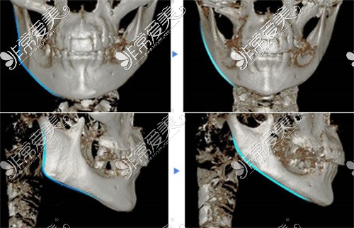 金一秀下颌角整形CT