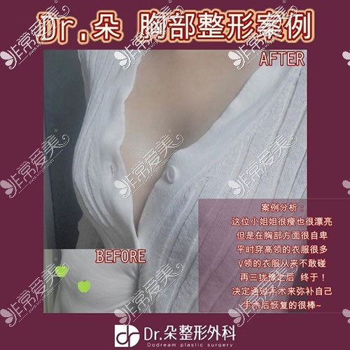 韩国dr朵假体隆胸手术术前照片