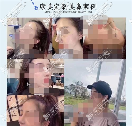 南京康美醫(yī)療美容隆鼻示意圖