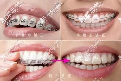 牙齿矫正常用方式