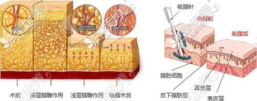 揭秘贵阳大腿吸脂多少钱？贵阳大腿吸脂好的医院分享