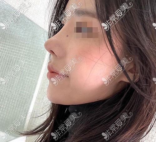 韩国优雅人隆鼻术后照片