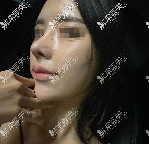 韩国优雅人隆鼻术后图片