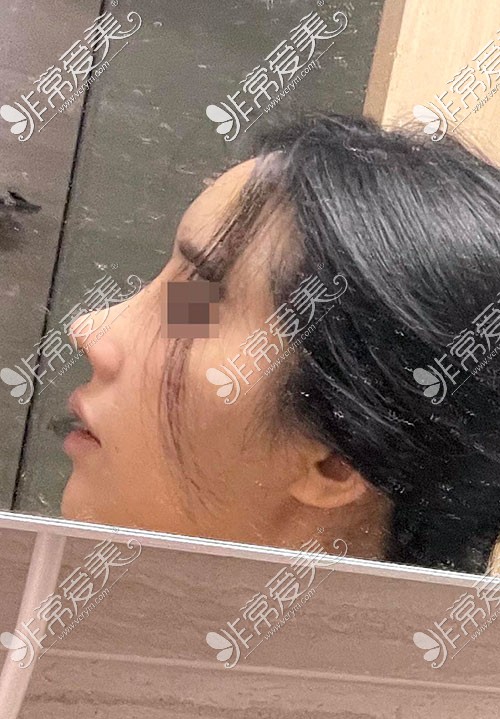 韩国优雅人翘鼻间手术图片
