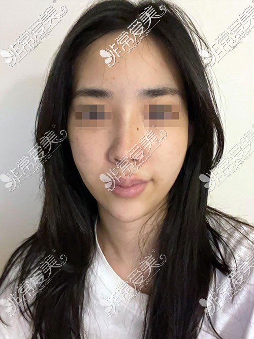 韩国优雅人整形隆鼻手术术前照片