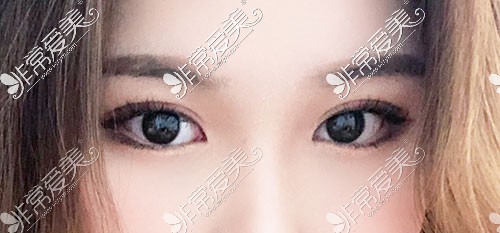 韩国yellow双眼皮术后照片