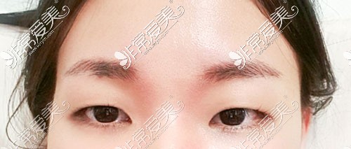 韩国yellow双眼皮手术术前图