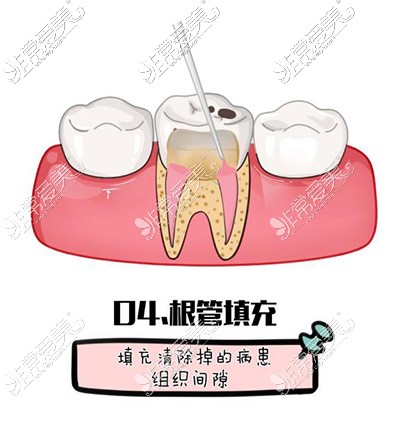 根管治疗卡通图展示照片