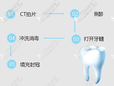 根管治疗过程展示