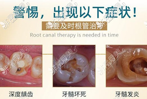 哪些情况出现要做根管治疗改善