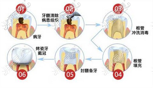 廣州廣大口腔門診部做根管治療過(guò)程