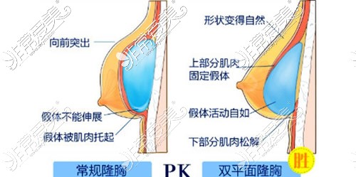 深圳军科整形隆胸手术特点分析