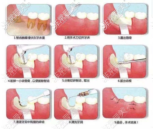 微创拔智齿的过程图解图片