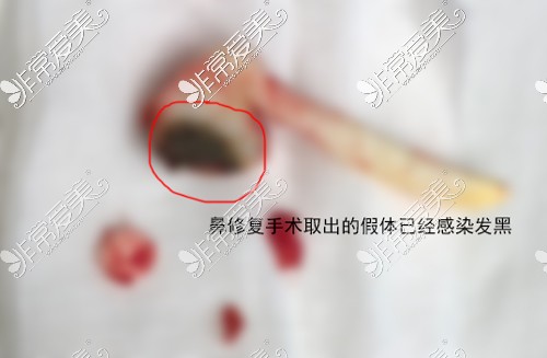 薛志强医生鼻修复手术取出已感染的假体