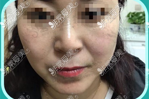 齐齐哈尔面部吸脂去哪好？君悦医疗美容医院面部吸脂展示