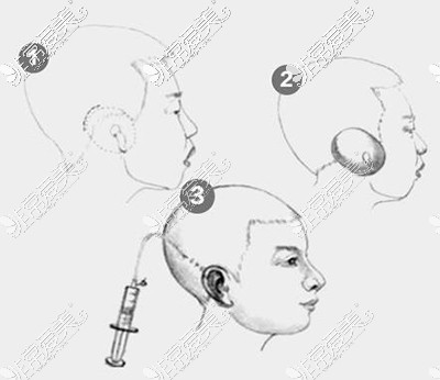 耳再造手術(shù)卡通一期示意