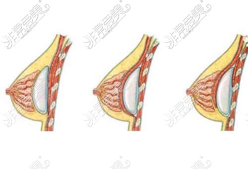 假体隆胸手术