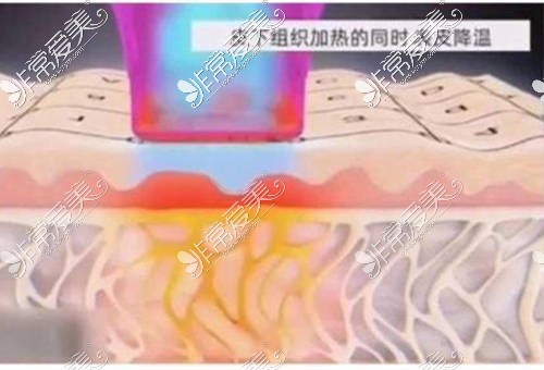 贵阳热玛吉官方授权医院有哪些?这几家正版授权价格还优惠