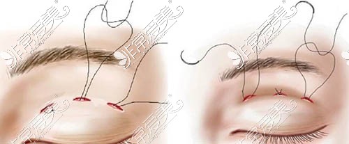 埋线双眼皮手术方法图解