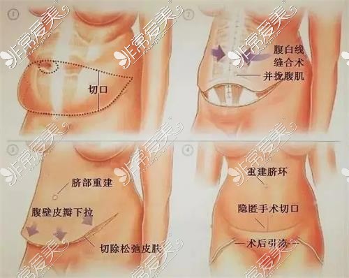 腹壁整形手术过程