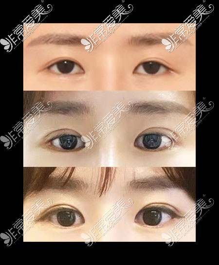 韩国icon整形双眼皮恢复过程