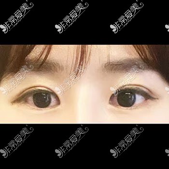 韩国icon整形双眼皮术后照