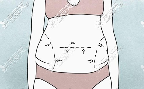 腰腹部吸脂卡通图展示