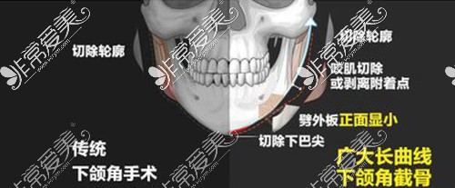 广州广大医院做下颌角整形的优势特色