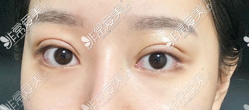 韩国yellow双眼皮修复图