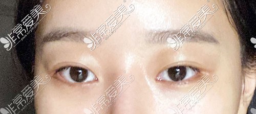 韩国yellow整形双眼皮修复术前照