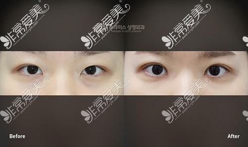 韩国普拉美斯双眼皮手术照片