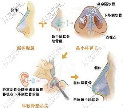 鼻整形卡通图展示照片