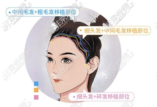 杭州首瑞植发长发分区种植方法图示