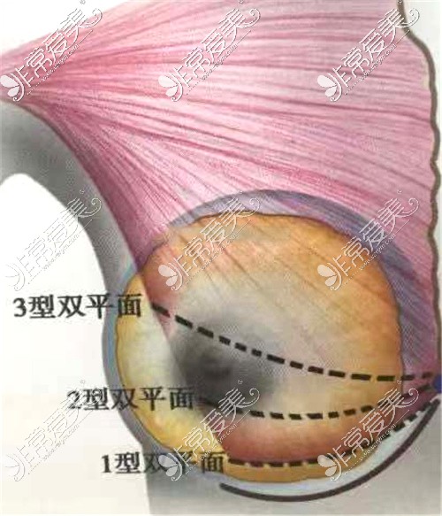 双平面丰胸的不同程度