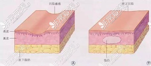 脂肪填充示意图