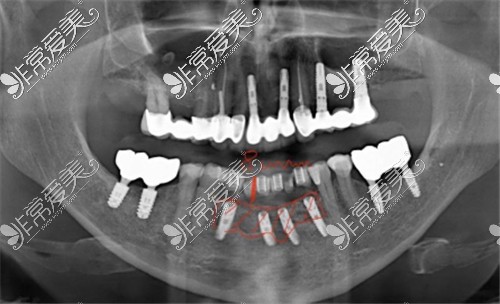 多颗种植体种植影像图