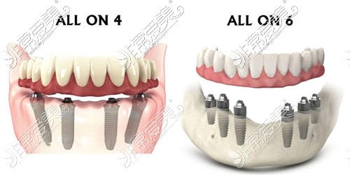 all-on-4、all-on-6种植对比