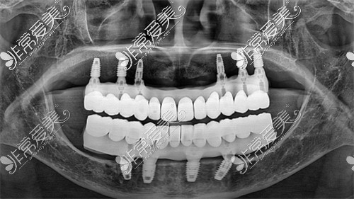 上面6顆植體下面4顆植體修復(fù)