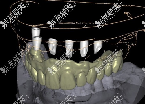 半口種植牙6顆植體設(shè)計(jì)