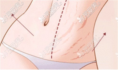 成都棕南医院祛妊娠纹卡通图