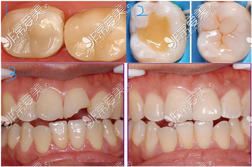 补牙修复过程