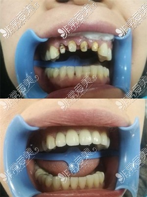 铁岭方辉口腔诊所牙齿修复对比