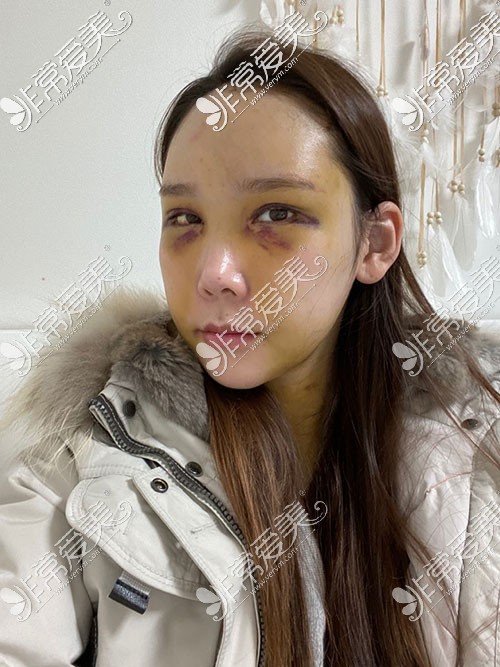 韩国芙莱思整形面部吸脂照片